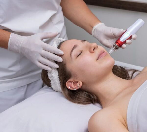 Client receiving a microneedling aesthetics treatment